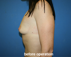 plastic-surgery-breast-augmentation